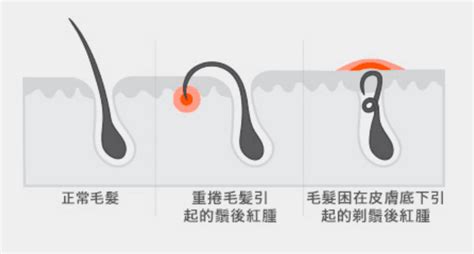 毛髮倒生皮膚科|毛髮倒長老是冒痘痘或發炎？專業皮膚科醫生告訴你。